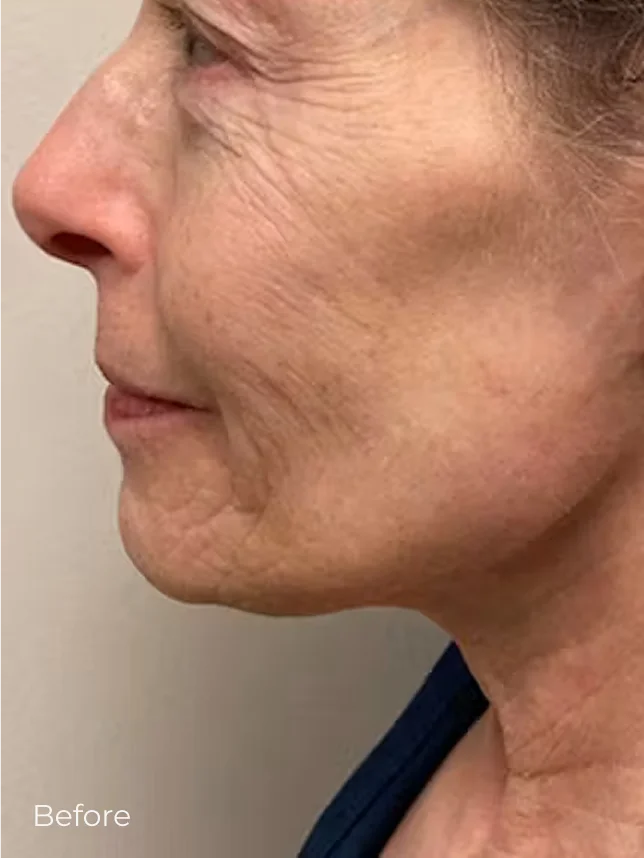 Woman's profile showing facial wrinkles and sagging skin before cosmetic treatment procedure