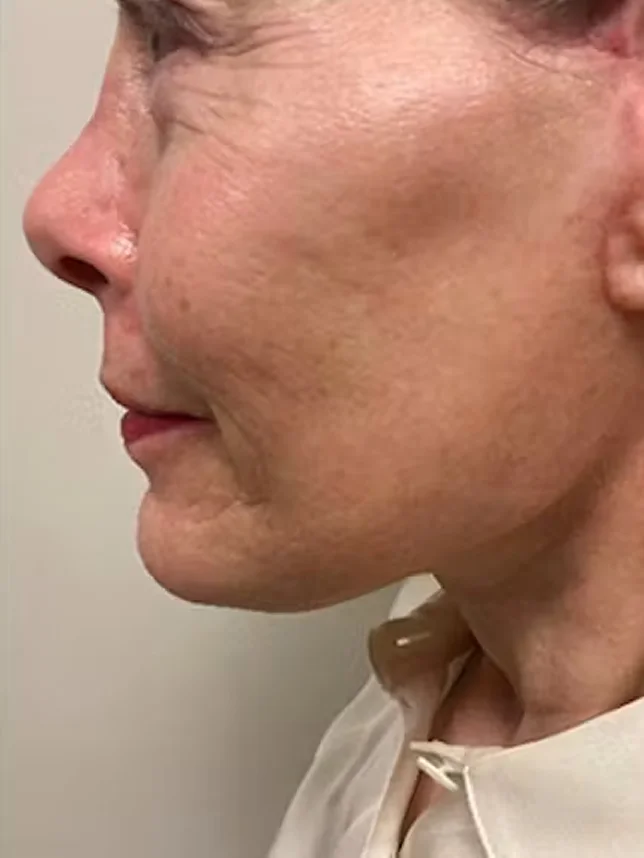 Woman's profile showing facial skin texture and jawline before cosmetic treatment procedure