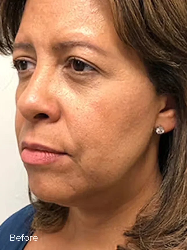 Woman's face showing aging signs including wrinkles and sagging skin before cosmetic treatment procedure