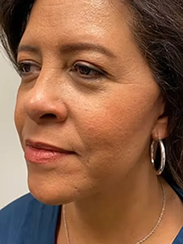 Woman showing smooth facial skin results after cosmetic treatment, side profile view