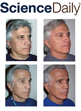 Before and after photos showing facial cosmetic surgery results from multiple angles on white background