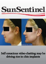 Before and after chin implant surgery showing profile view comparison from SunSentinel publication
