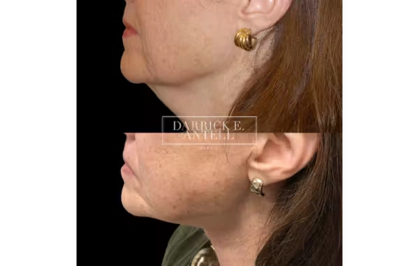 1737154117-lipoma-removal-1