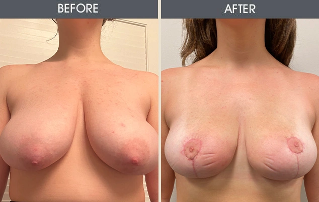 Real patient results in New York, NY Performed by Darrick E. Antell MD, FACS