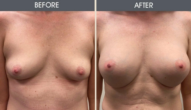 Real patient results in New York, NY Performed by Darrick E. Antell MD, FACS