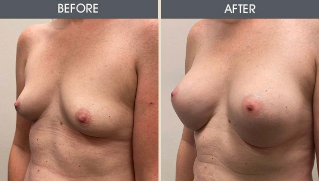 Real patient results in New York, NY Performed by Darrick E. Antell MD, FACS