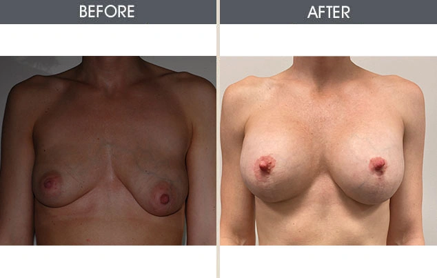 Real patient results in New York, NY Performed by Darrick E. Antell MD, FACS