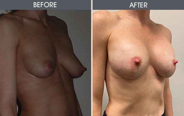 Real patient results in New York, NY Performed by Darrick E. Antell MD, FACS