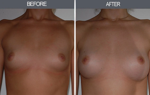 Real patient results in New York, NY Performed by Darrick E. Antell MD, FACS