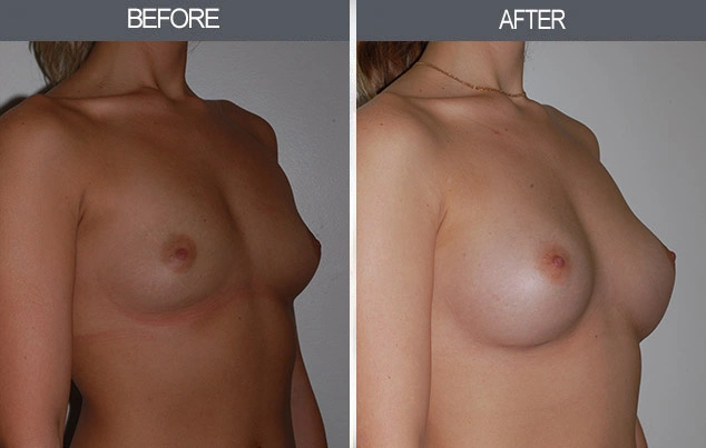 Real patient results in New York, NY Performed by Darrick E. Antell MD, FACS