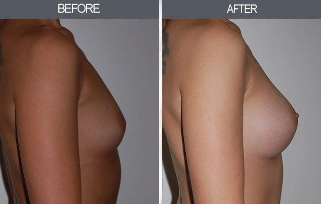 Real patient results in New York, NY Performed by Darrick E. Antell MD, FACS