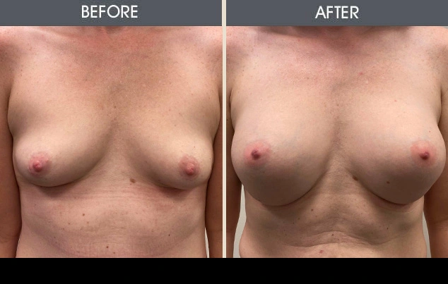 Real patient results in New York, NY Performed by Darrick E. Antell MD, FACS