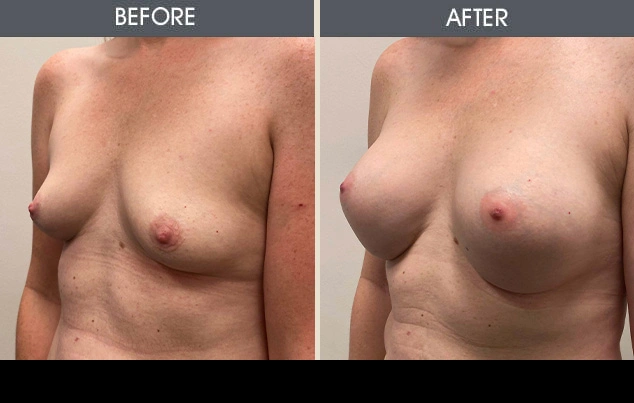 Real patient results in New York, NY Performed by Darrick E. Antell MD, FACS