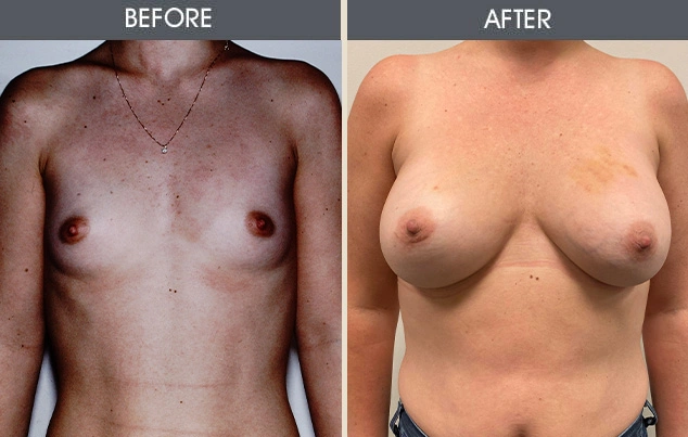 Real patient results in New York, NY Performed by Darrick E. Antell MD, FACS