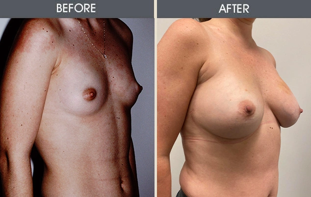 Real patient results in New York, NY Performed by Darrick E. Antell MD, FACS