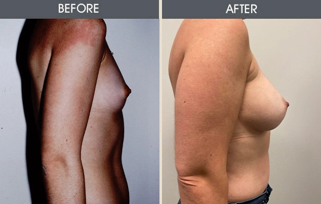 Real patient results in New York, NY Performed by Darrick E. Antell MD, FACS