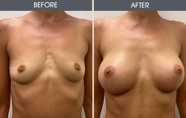 Real patient results in New York, NY Performed by Darrick E. Antell MD, FACS