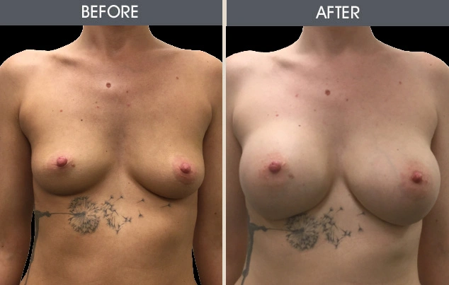 Real patient results in New York, NY Performed by Darrick E. Antell MD, FACS