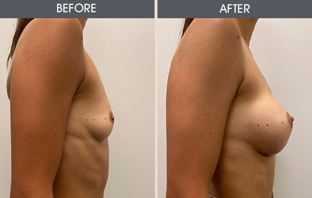 Real patient results in New York, NY Performed by Darrick E. Antell MD, FACS