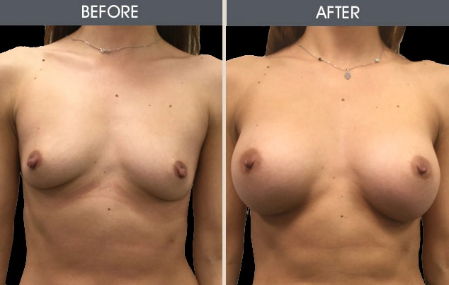 Real patient results in New York, NY Performed by Darrick E. Antell MD, FACS