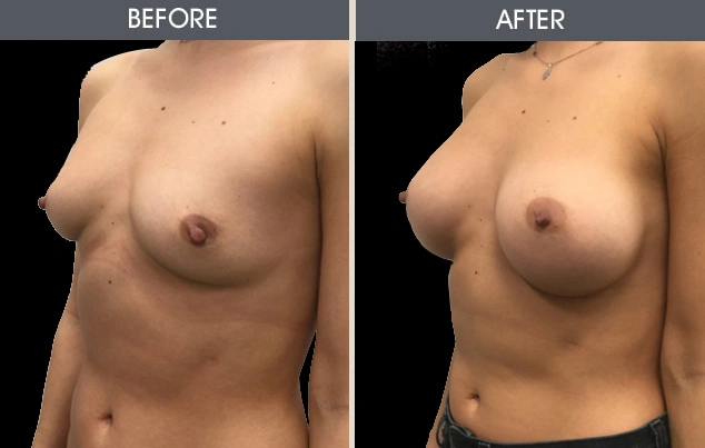 Real patient results in New York, NY Performed by Darrick E. Antell MD, FACS