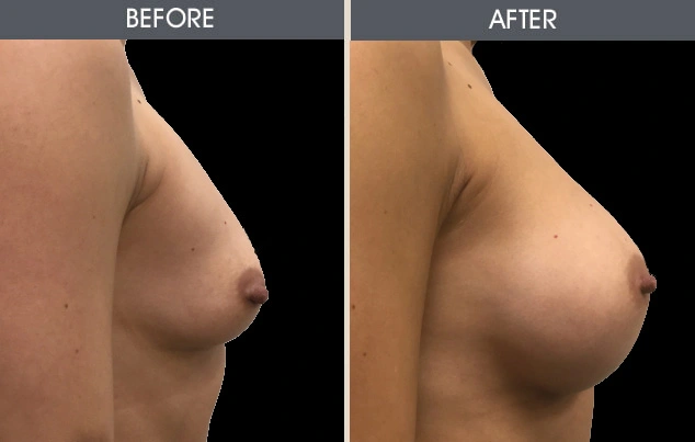 Real patient results in New York, NY Performed by Darrick E. Antell MD, FACS