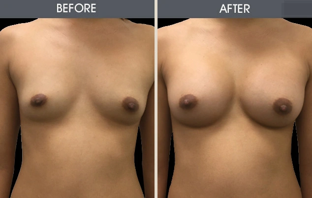 Real patient results in New York, NY Performed by Darrick E. Antell MD, FACS