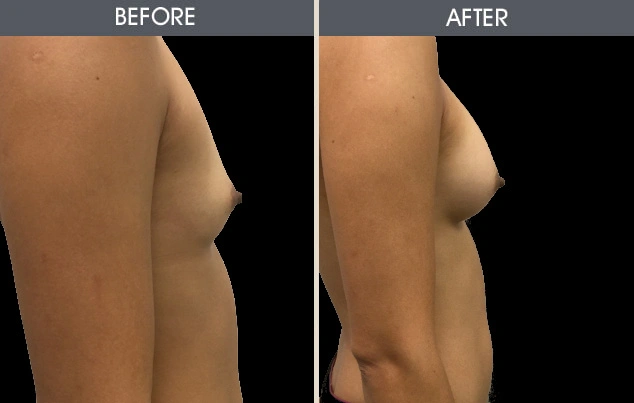Real patient results in New York, NY Performed by Darrick E. Antell MD, FACS