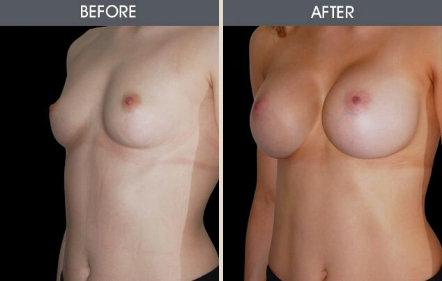 Real patient results in New York, NY Performed by Darrick E. Antell MD, FACS