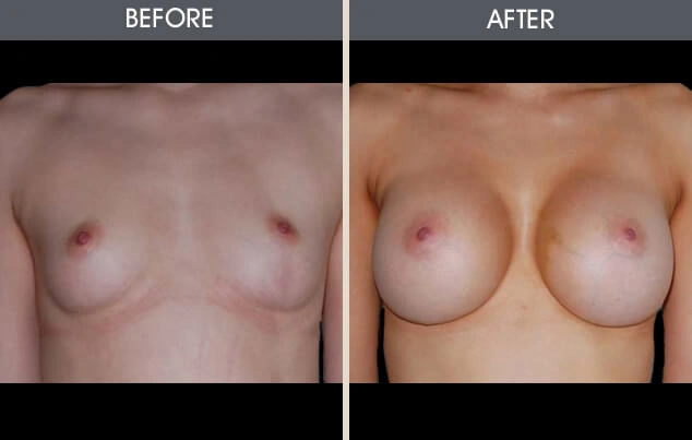 Real patient results in New York, NY Performed by Darrick E. Antell MD, FACS