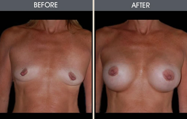 Real patient results in New York, NY Performed by Darrick E. Antell MD, FACS