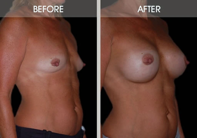 Real patient results in New York, NY Performed by Darrick E. Antell MD, FACS