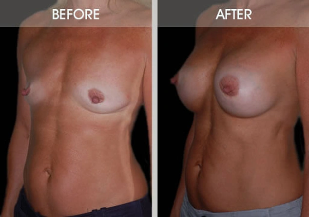 Real patient results in New York, NY Performed by Darrick E. Antell MD, FACS