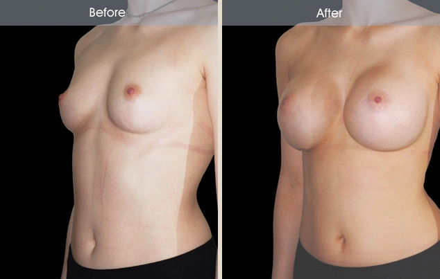 Real patient results in New York, NY Performed by Darrick E. Antell MD, FACS