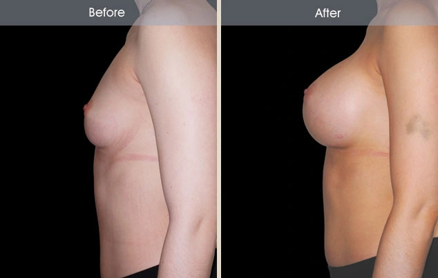 Real patient results in New York, NY Performed by Darrick E. Antell MD, FACS