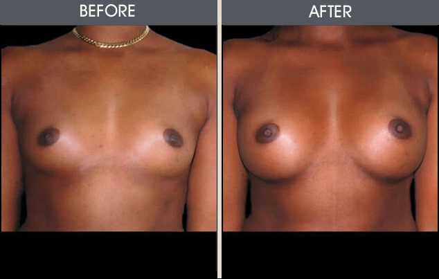 Real patient results in New York, NY Performed by Darrick E. Antell MD, FACS