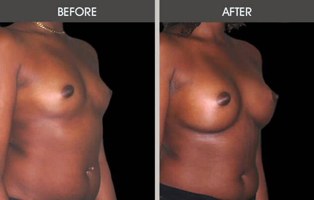 Real patient results in New York, NY Performed by Darrick E. Antell MD, FACS
