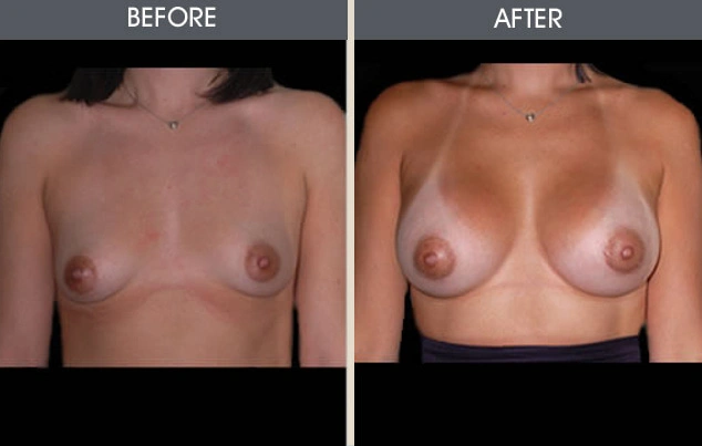 Real patient results in New York, NY Performed by Darrick E. Antell MD, FACS