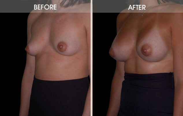 Real patient results in New York, NY Performed by Darrick E. Antell MD, FACS