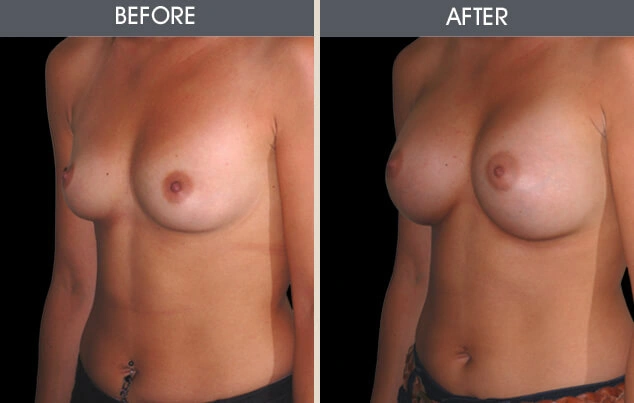 Real patient results in New York, NY Performed by Darrick E. Antell MD, FACS