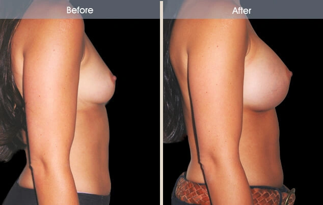 Real patient results in New York, NY Performed by Darrick E. Antell MD, FACS