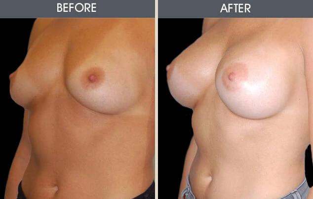 Real patient results in New York, NY Performed by Darrick E. Antell MD, FACS
