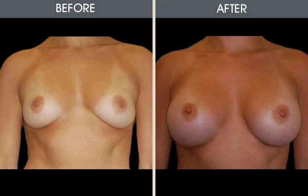 Real patient results in New York, NY Performed by Darrick E. Antell MD, FACS