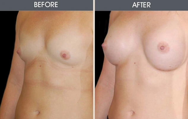 Real patient results in New York, NY Performed by Darrick E. Antell MD, FACS