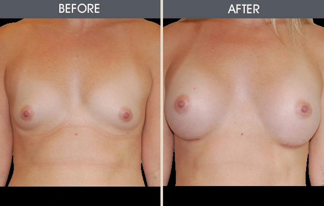 Real patient results in New York, NY Performed by Darrick E. Antell MD, FACS