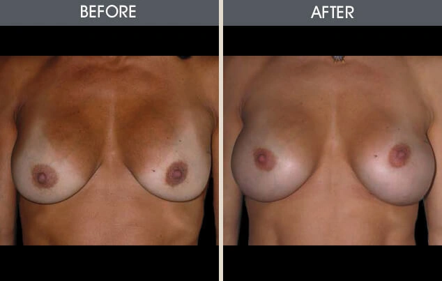 Real patient results in New York, NY Performed by Darrick E. Antell MD, FACS