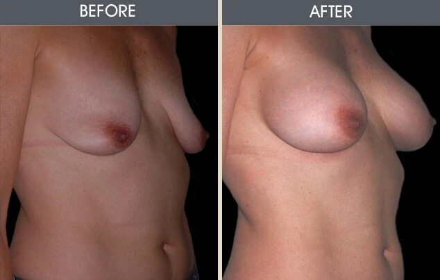 Real patient results in New York, NY Performed by Darrick E. Antell MD, FACS