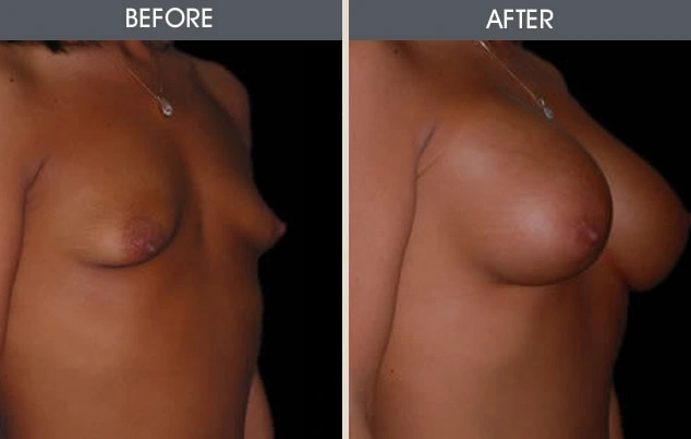 Real patient results in New York, NY Performed by Darrick E. Antell MD, FACS