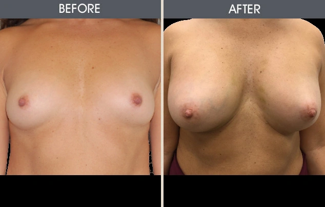 Real patient results in New York, NY Performed by Darrick E. Antell MD, FACS