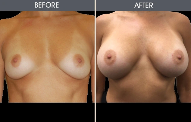 Real patient results in New York, NY Performed by Darrick E. Antell MD, FACS